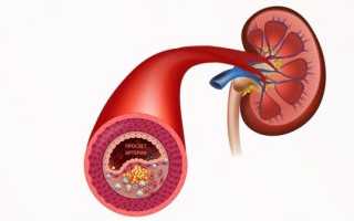 Нефросклероз почек: причины возникновения и методы лечения