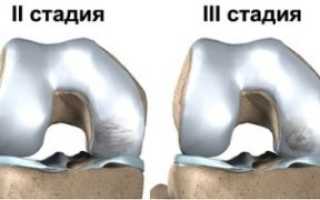 Болезнь Кенига коленного сустава. Что это такое, лечение, стадии у детей, спортсменов, взрослых, операция