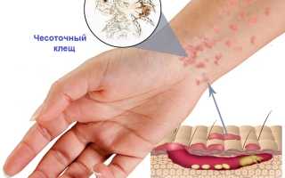 Чесотка при беременности