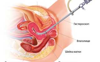 Каковы шансы забеременеть после проведения гистероскопии?