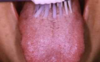 Почему на языке возникает желтый налет?