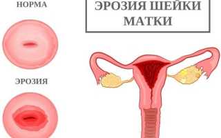 После прижигания эрозии шейки матки выделения это нормально или патология