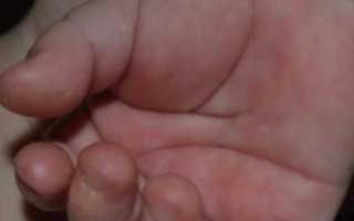 Шелушатся ладошки — что делать?