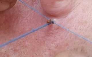 Что делать если укусил энцефалитный клещ ребенка