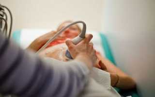 Брадикардия плода при беременности, причины и диагностика