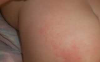 Из-за чего на попе появляются красные пятна