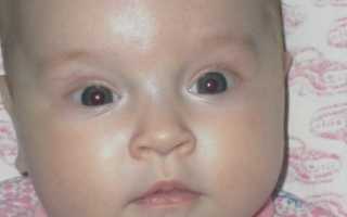Синева вокруг рта у грудничка