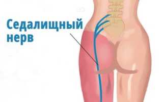 Что делать, если болит седалищный нерв при беременности?