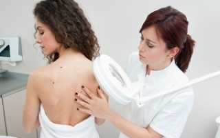 Бородавки во время беременности и методы их удаления