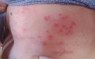 Если сыпь на животе при беременности чешется