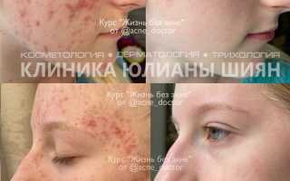 Прыщи? Не только у подростков! (И это нормально)