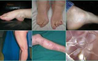 Недифференцированная дисплазия соединительной ткани с позиции дизэлементоза у детей и подростков