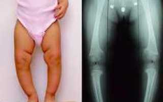 Лечим рахит у грудничка