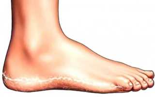 Паховая эпидермофития у мужчин: причины, симптомы и лечение