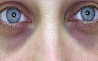 Темные круги под глазами: откуда они и что с ними делать