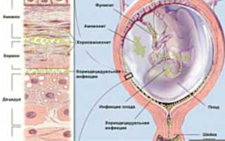 Как лечить микоплазмоз при беременности