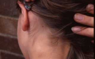 Действия при увеличенных лимфоузлах