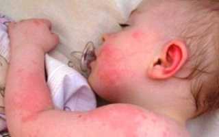 Почему возникает у грудничков аллергия на сахар