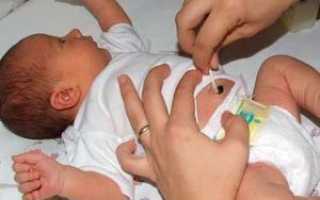 Причины появления и лечение пупочной грыжи