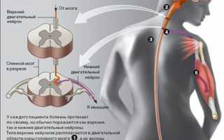 Амиотрофический боковой склероз: что это такое, симптомы, лечение