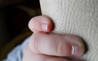 Почему у ребенка слоятся ногти