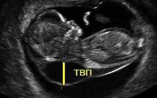 Что такое воротниковое пространство у плода и о чем говорит его увеличение?