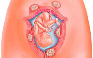 Возможно ли удаление миомы матки при кесаревом сечении?