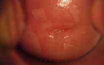 Паракератоз плоского эпителия шейки матки что это такое