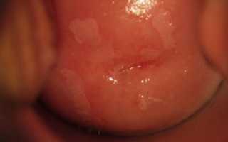 Паракератоз плоского эпителия шейки матки что это такое