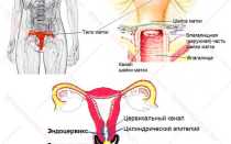 Что такое дисплазия шейки матки второй степени и как её лечить?