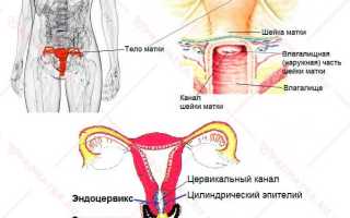 Что такое дисплазия шейки матки второй степени и как её лечить?