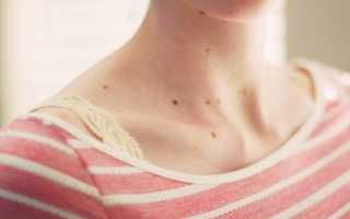 Родинки при беременности: когда невус нужно удалять?