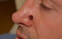 Рак кожи: фото, симптомы, первые признаки 324617 12