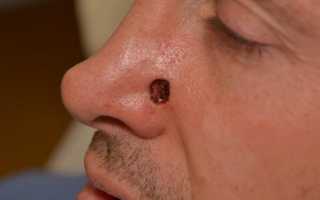 Рак кожи: фото, симптомы, первые признаки 324617 12