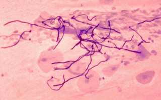 Как лечить кандидозный стоматит у детей?
