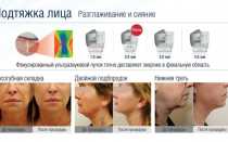 Ulthera (Альтера) – аппарат для омоложения лица ультразвуковым лифтингом. Отзывы