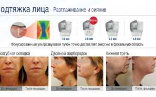 Ulthera (Альтера) – аппарат для омоложения лица ультразвуковым лифтингом. Отзывы