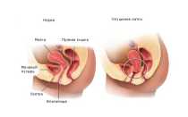 Как выбрать и установить маточные кольца при выпадении матки