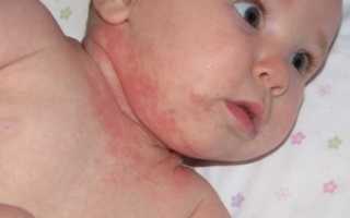 Лечение мелких прыщиков на лице и шее у грудничка