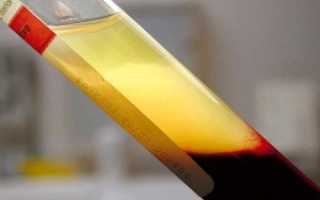 Проведение плазмафереза при беременности и бесплодии