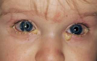 Что делать при конъюнктивите у ребенка?