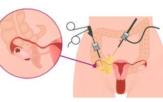 Лапароскопия при поликистозе яичников: подготовка, проведение и период после операции