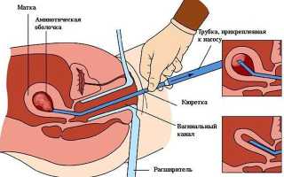 Диагностическая вакуум-аспирация содержимого полости матки (ДВА)