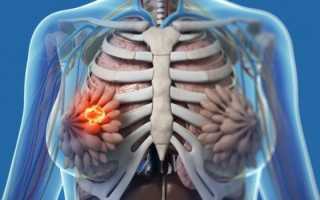 Доброкачественная дисплазия молочной железы: что это такое и как лечить?