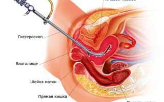 Когда начинаются и какие месячные после гистероскопии