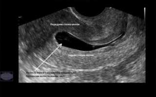 Признаки и методы лечения серозометры в постменопаузе