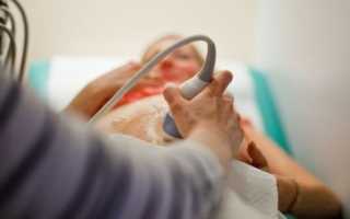 Чем опасна вентрикуломегалия для плода?