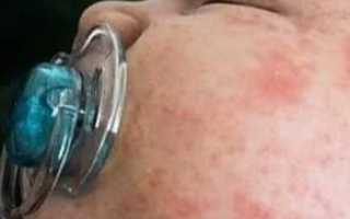 Как проявляется стафилококк у ребенка