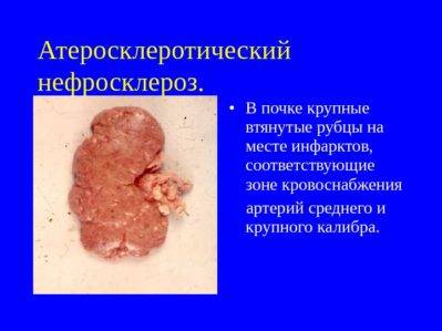 атеросклеротический нефросклероз