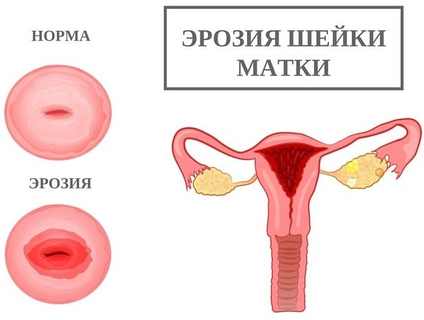 Беременность при эрозии шейки матки. Возможна ли, последствия, выделения, признаки, прижигание